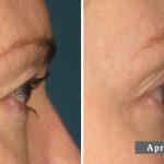SOURCIS - L’ULTHÉRAPIE – UN LIFTING SANS CHIRURGIE - EYEBROWS - ULTHERA TREATMENT - A NON-SURGICAL WAY TO LIFT SKIN