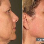 COU - L’ULTHÉRAPIE – UN LIFTING SANS CHIRURGIE – NECK - ULTHERA TREATMENT - A NON-SURGICAL WAY TO LIFT SKIN