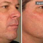 COU HOMME - L’ULTHÉRAPIE – UN LIFTING SANS CHIRURGIE - MAN NECK - ULTHERA TREATMENT - A NON-SURGICAL WAY TO LIFT SKIN