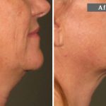 COU - L’ULTHÉRAPIE – UN LIFTING SANS CHIRURGIE – NECK - ULTHERA TREATMENT - A NON-SURGICAL WAY TO LIFT SKIN