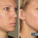 COU - L’ULTHÉRAPIE – UN LIFTING SANS CHIRURGIE - NECK - ULTHERA TREATMENT - A NON-SURGICAL WAY TO LIFT SKIN