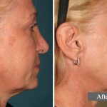 COU - L’ULTHÉRAPIE – UN LIFTING SANS CHIRURGIE - NECK - ULTHERA TREATMENT - A NON-SURGICAL WAY TO LIFT SKIN