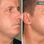 COU HOMME - L’ULTHÉRAPIE – UN LIFTING SANS CHIRURGIE - MAN NECK - ULTHERA TREATMENT - A NON-SURGICAL WAY TO LIFT SKIN