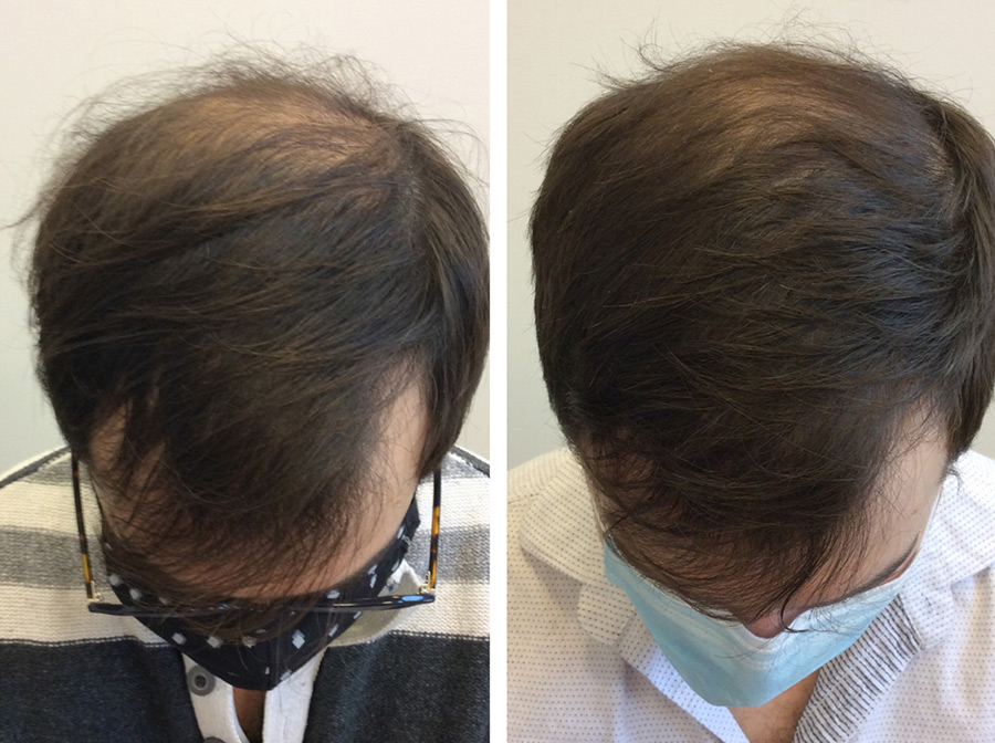 Platelet rich plasma (PRP) treatment has become an extremely useful modality for the treatment of hair loss.
